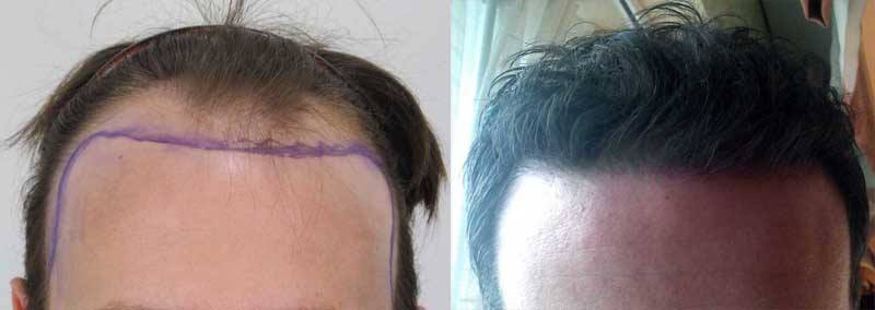 how to regrow hair on bald spot naturally